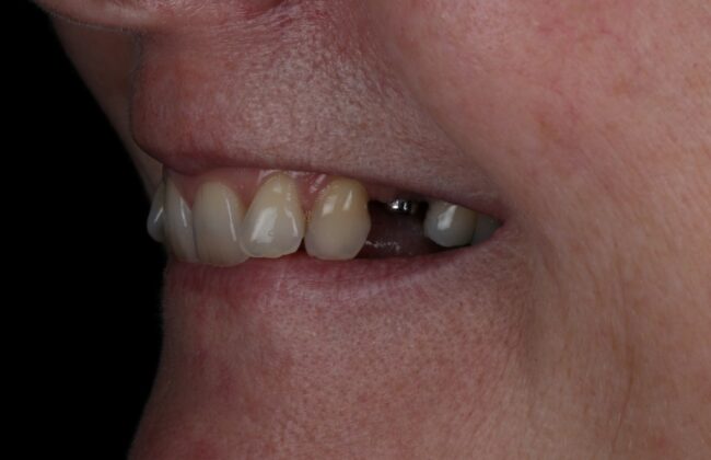Before (Teeth)