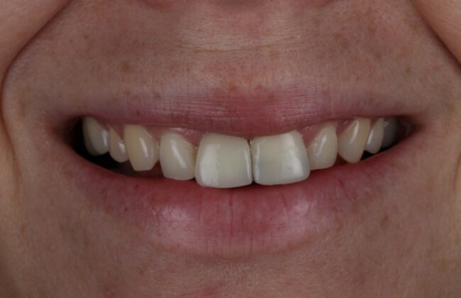 After (Teeth)