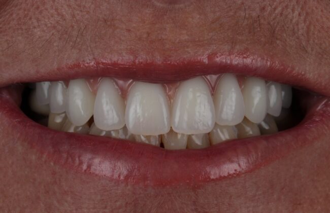 After (Teeth)