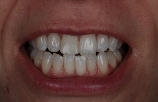 After (Teeth)