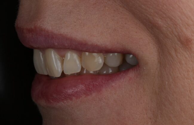 After (Teeth)