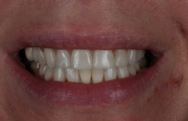 After (Teeth)