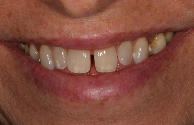 Before (Teeth)