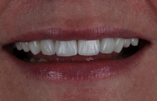 After (Teeth)