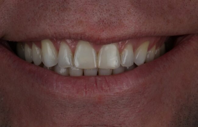 After (Teeth)