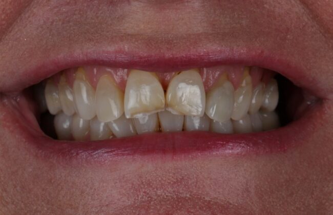 Before (Teeth)