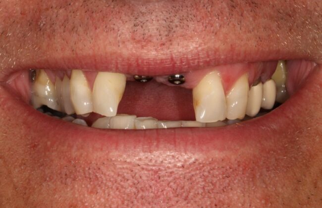 Before (Teeth)