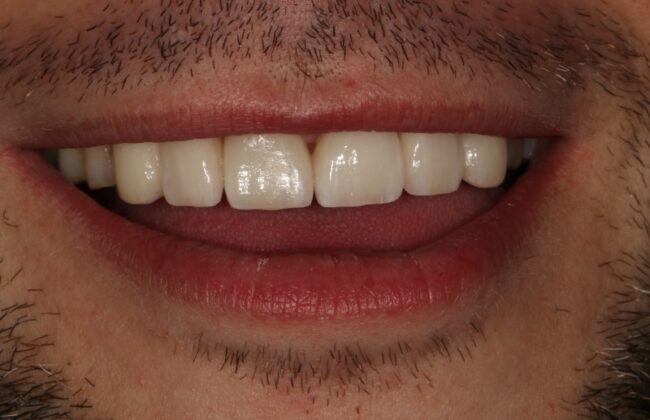 After (Teeth)