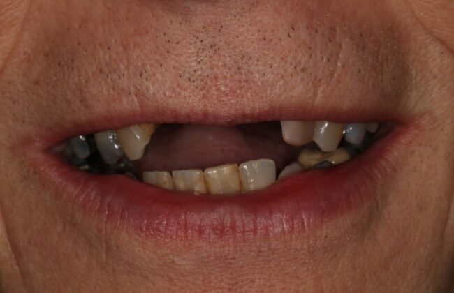 Before (Teeth)