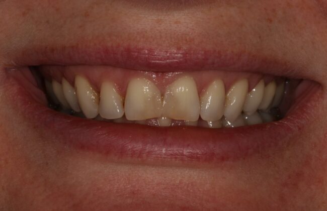 Before (Teeth)