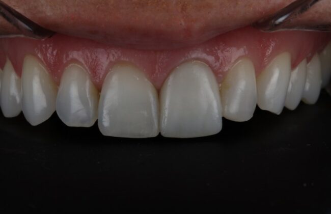 After (Teeth)