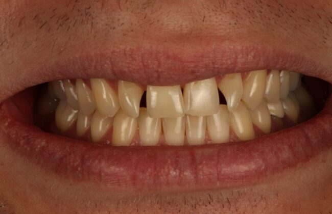 Before (Teeth)