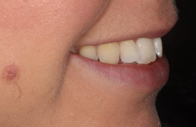 Before (Teeth)