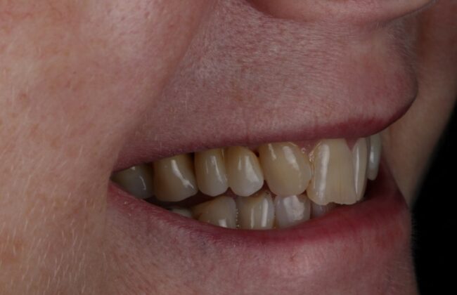 After (Teeth)