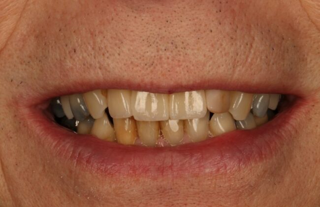 After (Teeth)