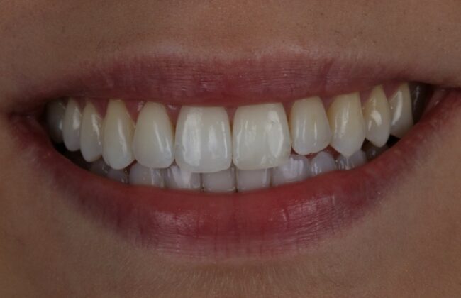After (Teeth)