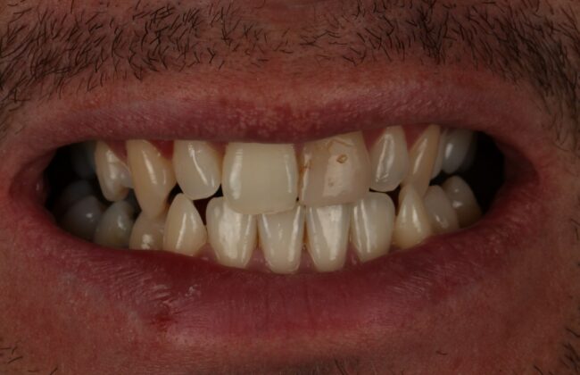 Before (Teeth)