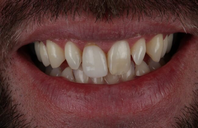 Before (Teeth)