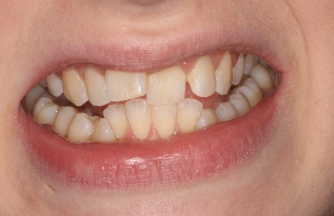 Before (Teeth)