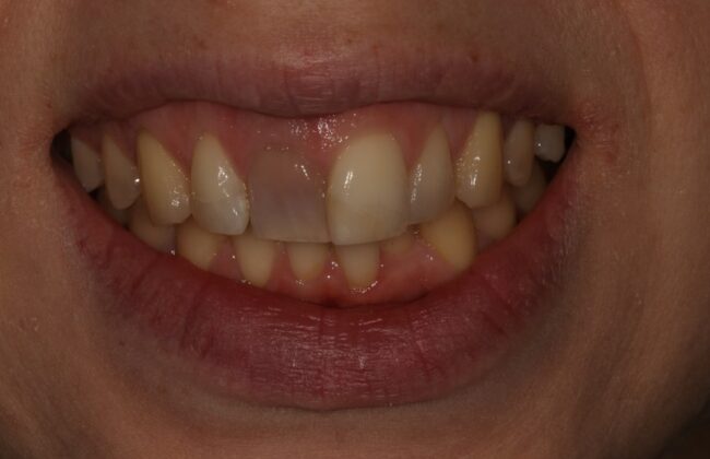 Before (Teeth)
