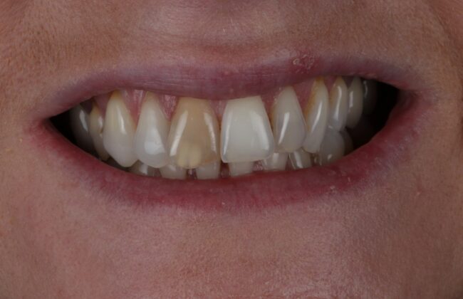 Before (Teeth)