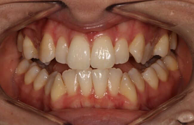 Before (Teeth)