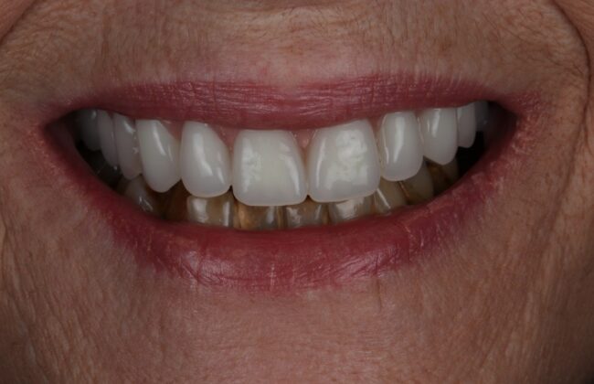 After (Teeth)