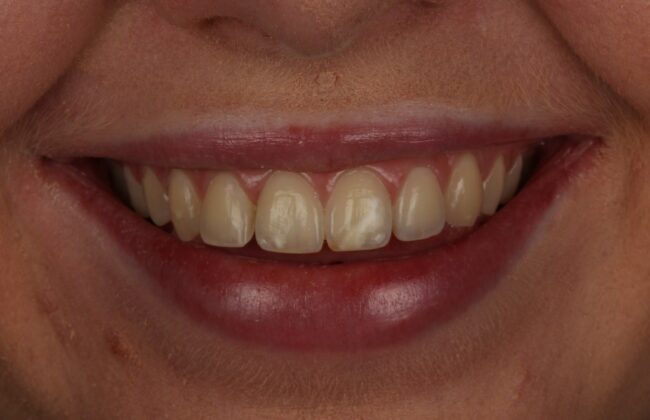 Before (Teeth)