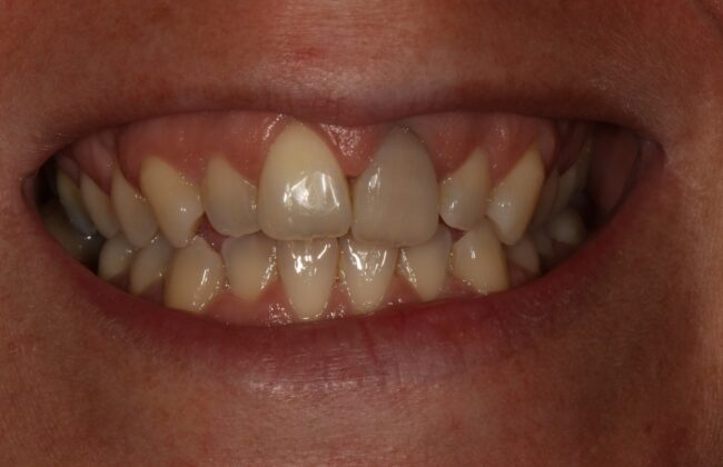 Before (Teeth)