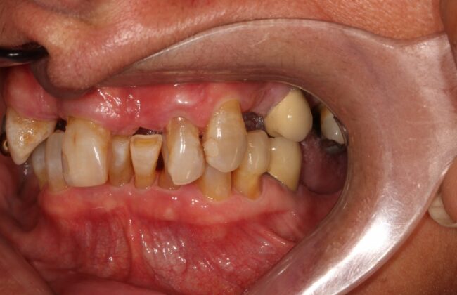 Before (Teeth)