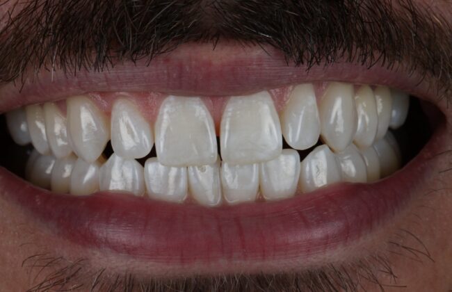 Before (Teeth)