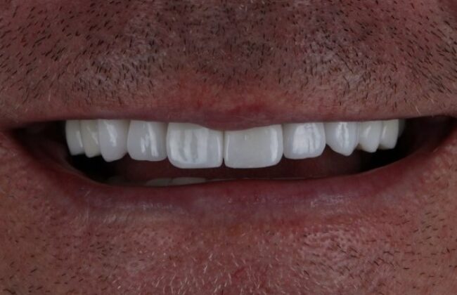 After (Teeth)