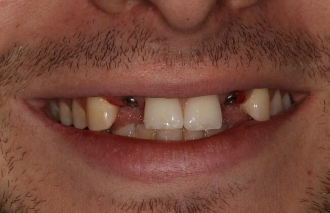 Before (Teeth)