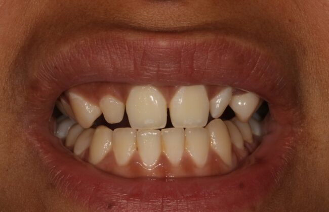 Before (Teeth)