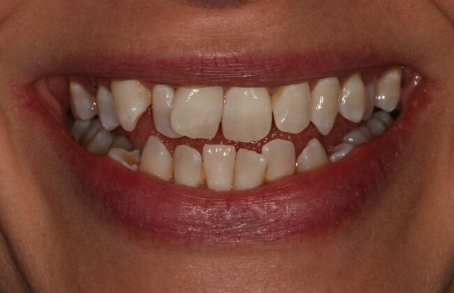 Before (Teeth)