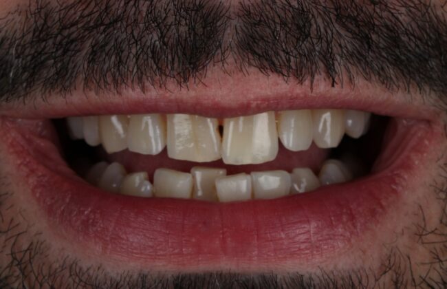 Before (Teeth)