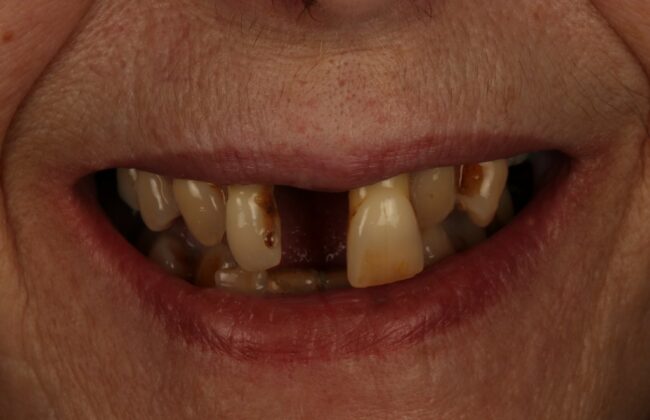 Before (Teeth)