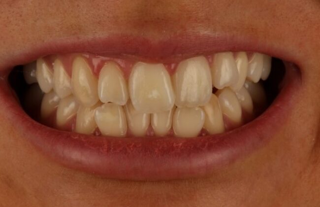 Before (Teeth)