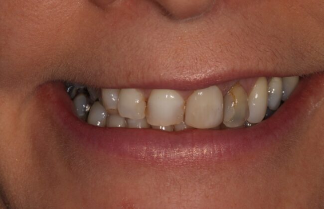 Before (Teeth)