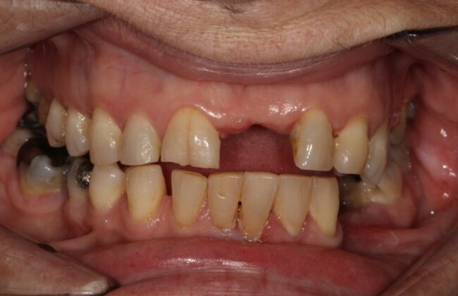 Before (Teeth)