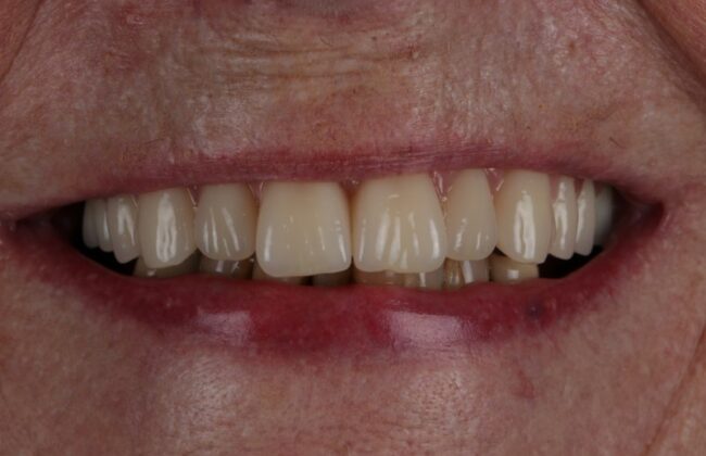 After (Teeth)