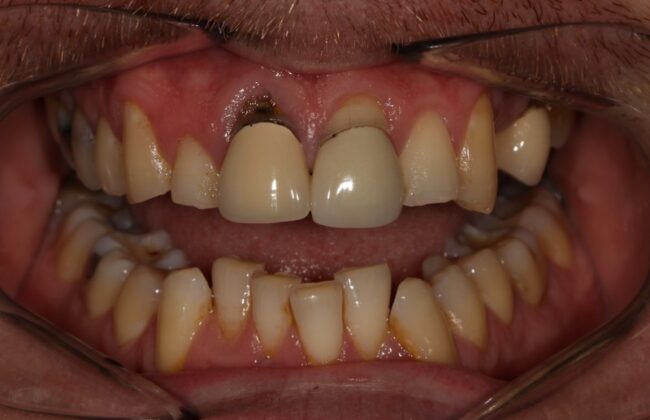 Before (Teeth)