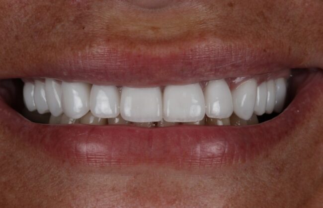 After (Teeth)