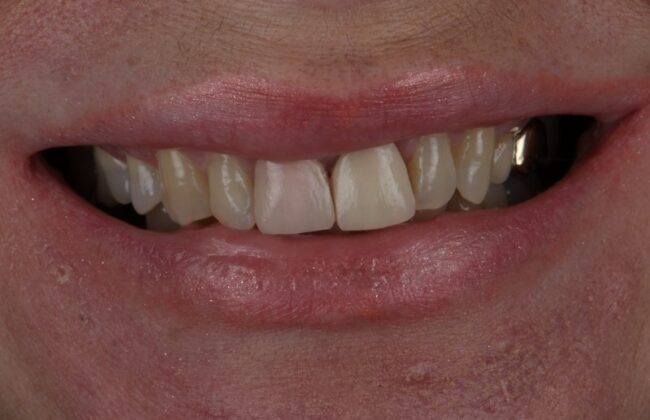 Before (Teeth)