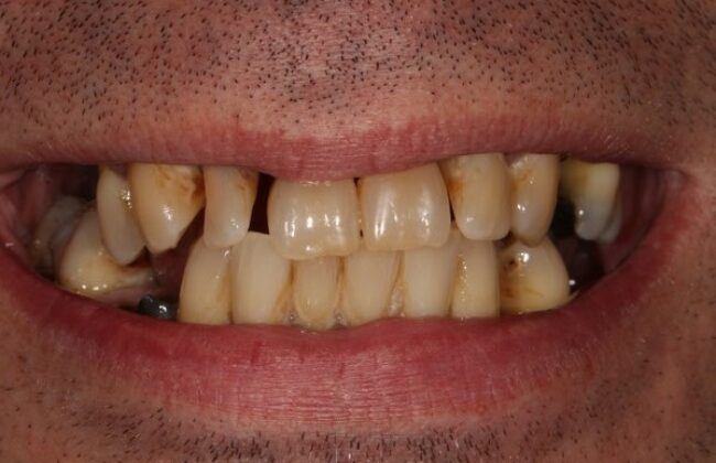 Before (Teeth)