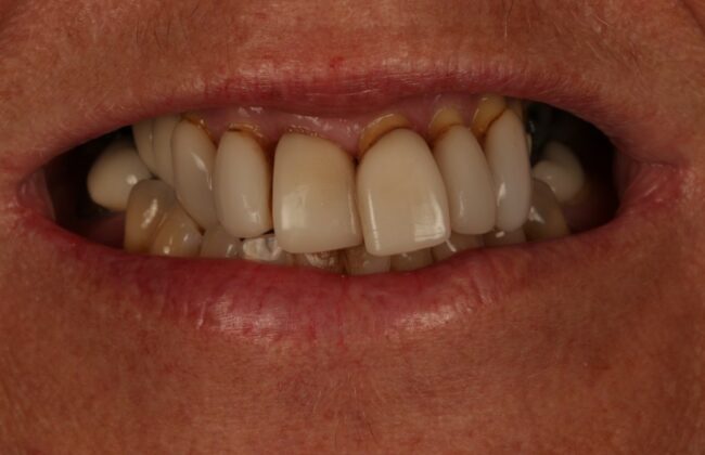 Before (Teeth)