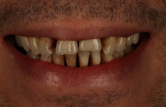 Before (Teeth)
