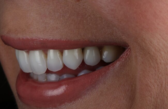 After (Teeth)