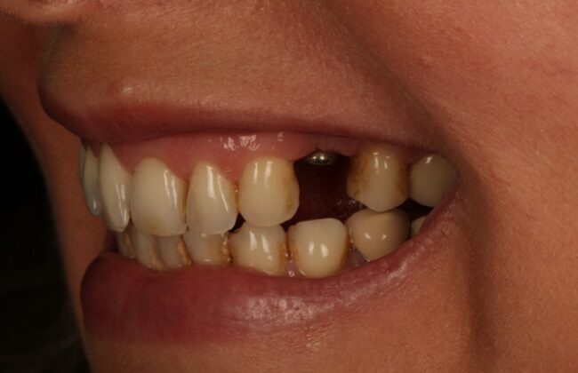 Before (Teeth)