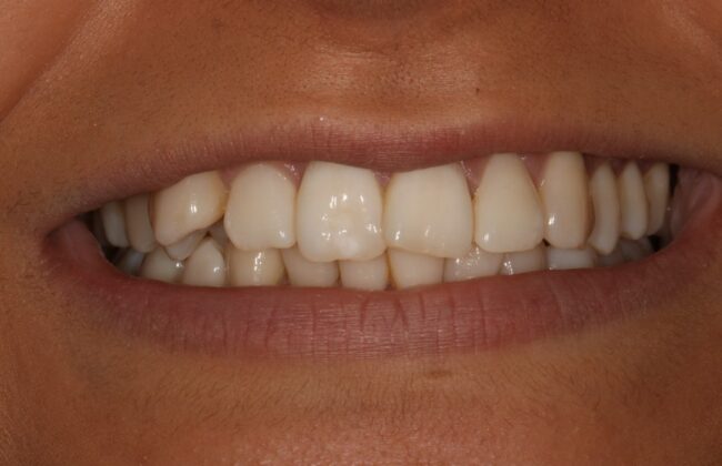 Before (Teeth)